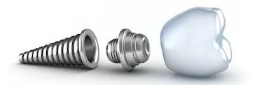 Dental implant diagram | Dentist in Charlestown