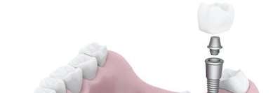 A diagram of dental implants in Charlestown NSW