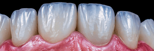 Detailed view of porcelain veneers on front teeth.