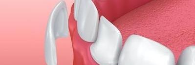 diagram of dental veneers in charlestown nsw